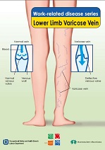 Lower Limb Varicose Vein
