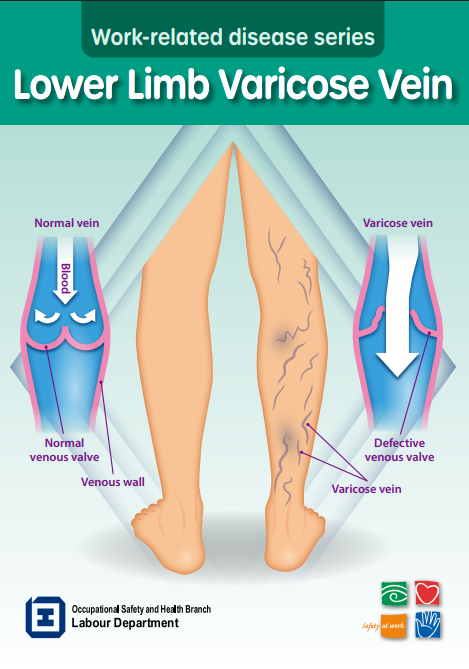 Lower Limb Varicose Vein