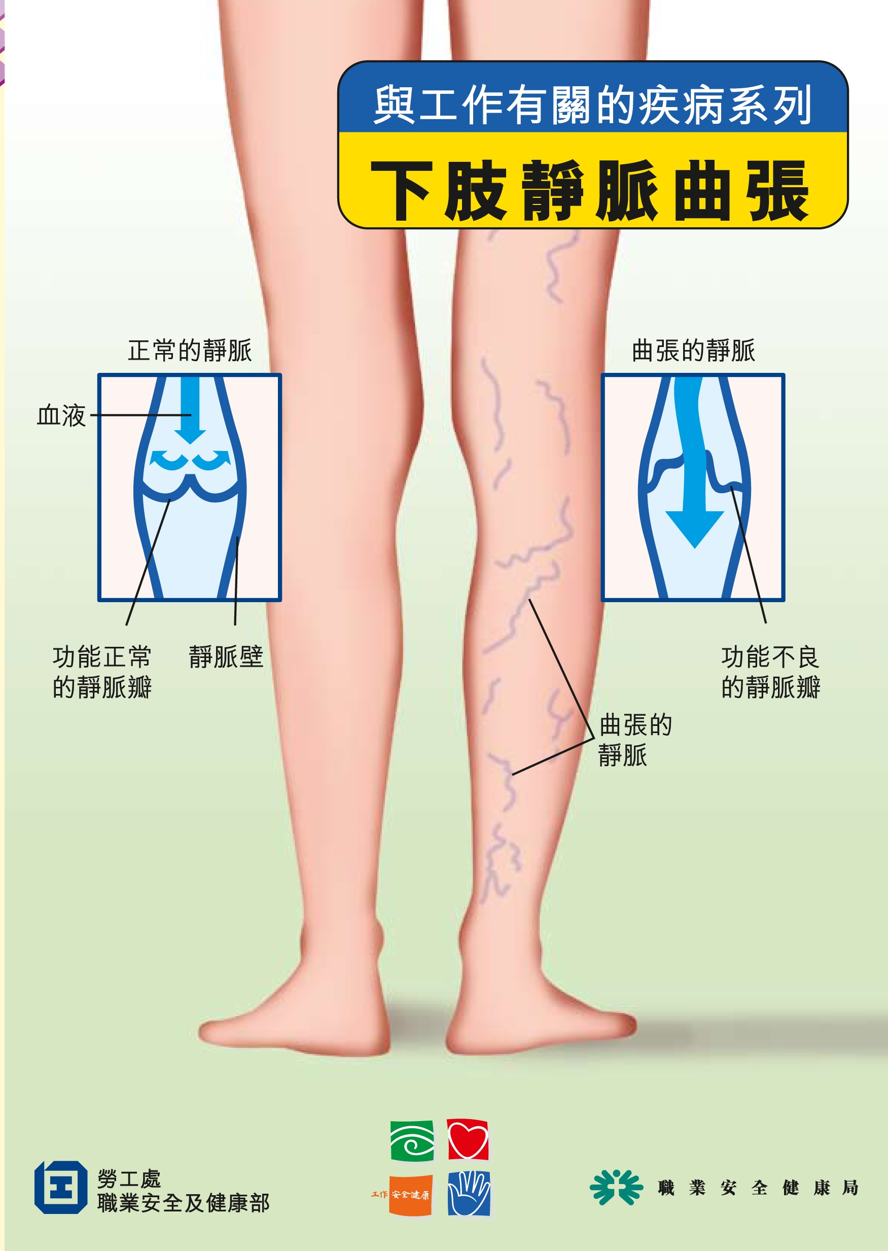 下肢靜脈曲張(勞工處刋物)
